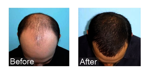 can hair regrow after chemotherapy